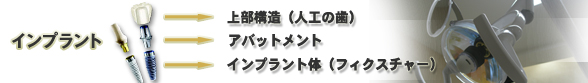 インプラント構造(上部構造、アバットメント、インプラント体)