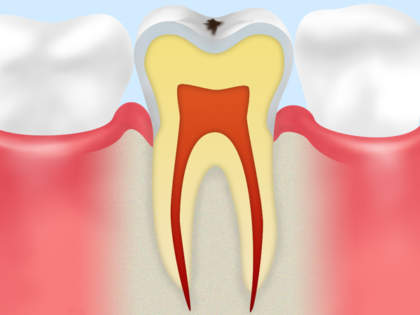 C0【初期の虫歯】