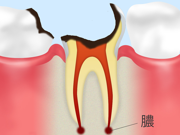 C4【歯根の虫歯】