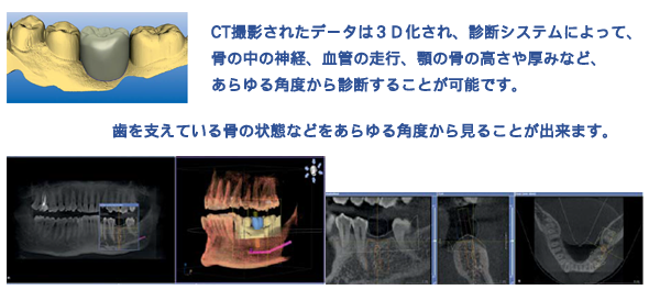 ORTHOPHOS XG 3D治療2